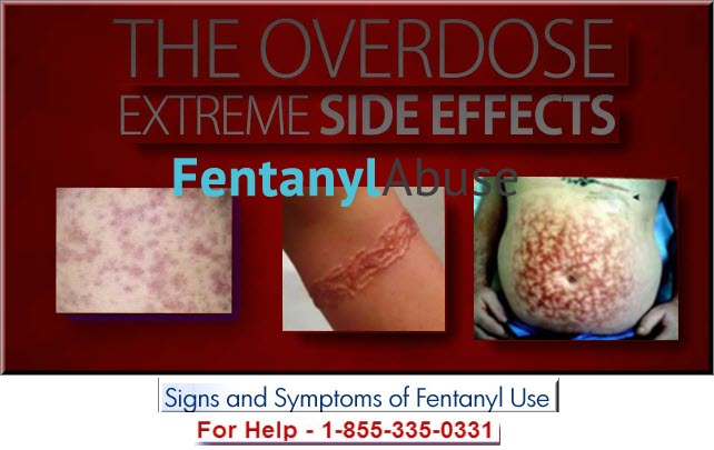 Fentanyl Patch Administration